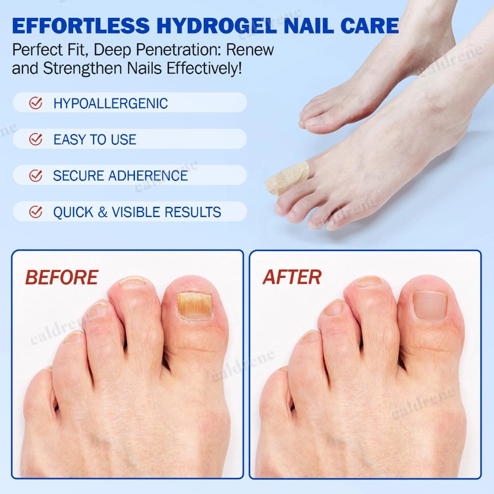 21-105PCS Toenail Antiseptic Patch Long Lasting Breathable Fungal Nail Patches – view 5