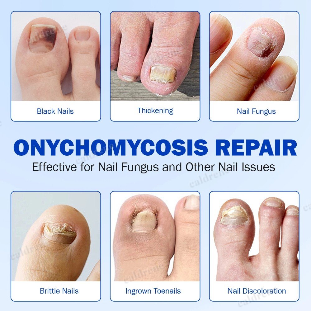 21-105PCS Toenail Antiseptic Patch Long Lasting Breathable Fungal Nail Patches – view 6