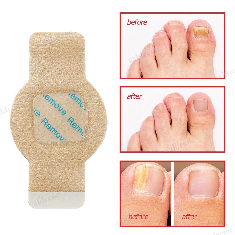 21-105PCS Toenail Antiseptic Patch Long Lasting Breathable Fungal Nail Patches – view 8