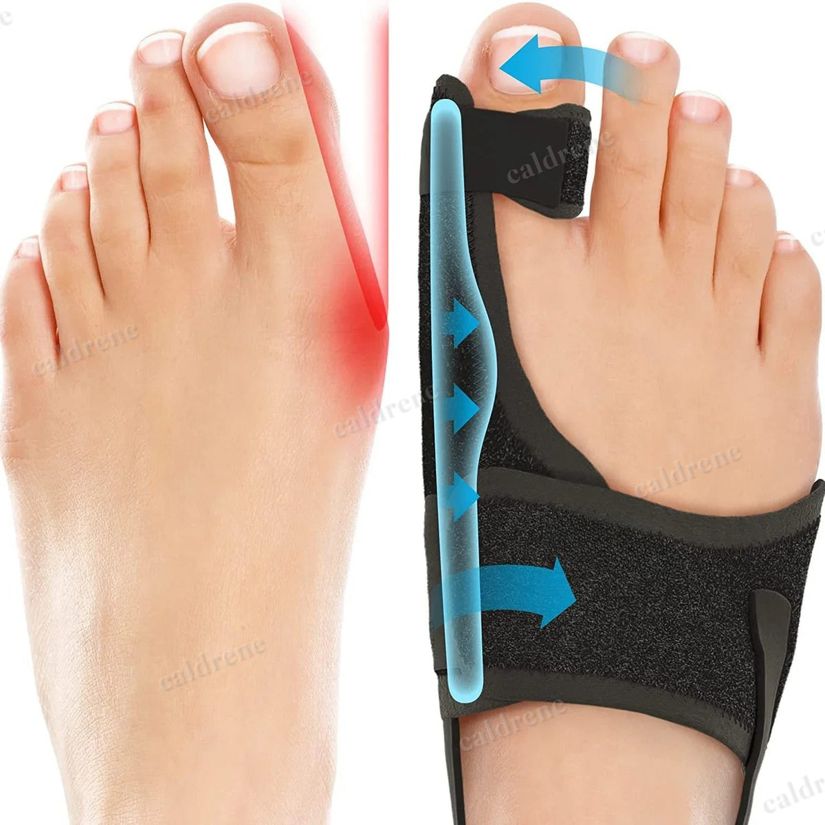 Orthopedic Bunion Splint Corrector Big Toe Separator Pain Relief Non-Surgical Ha – view 2