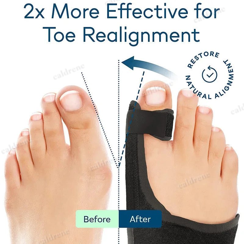 Orthopedic Bunion Splint Corrector Big Toe Separator Pain Relief Non-Surgical Ha – view 3