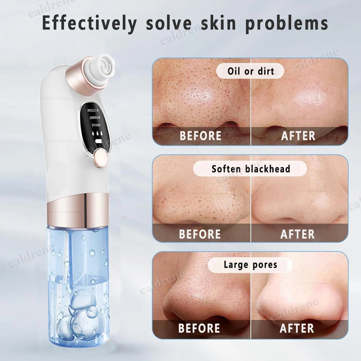 Pore Vacuum Cleaner for Gentle Blackhead Removal – view 5