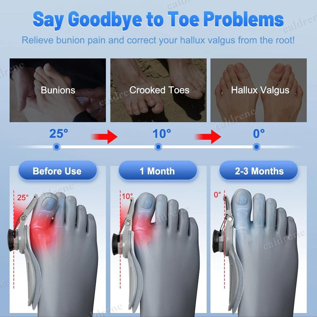 Treatmedy Bunion Fix Big Toe Straightener Adjustable Bunion Corrector – view 4
